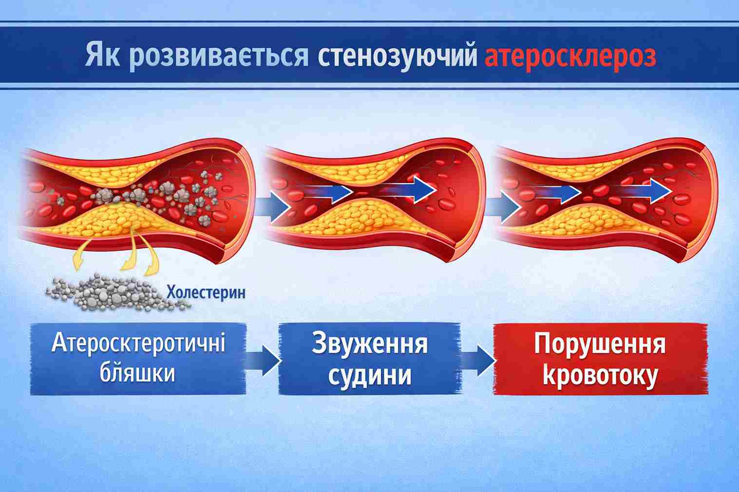 Як розвивається стенозуючий атеросклероз